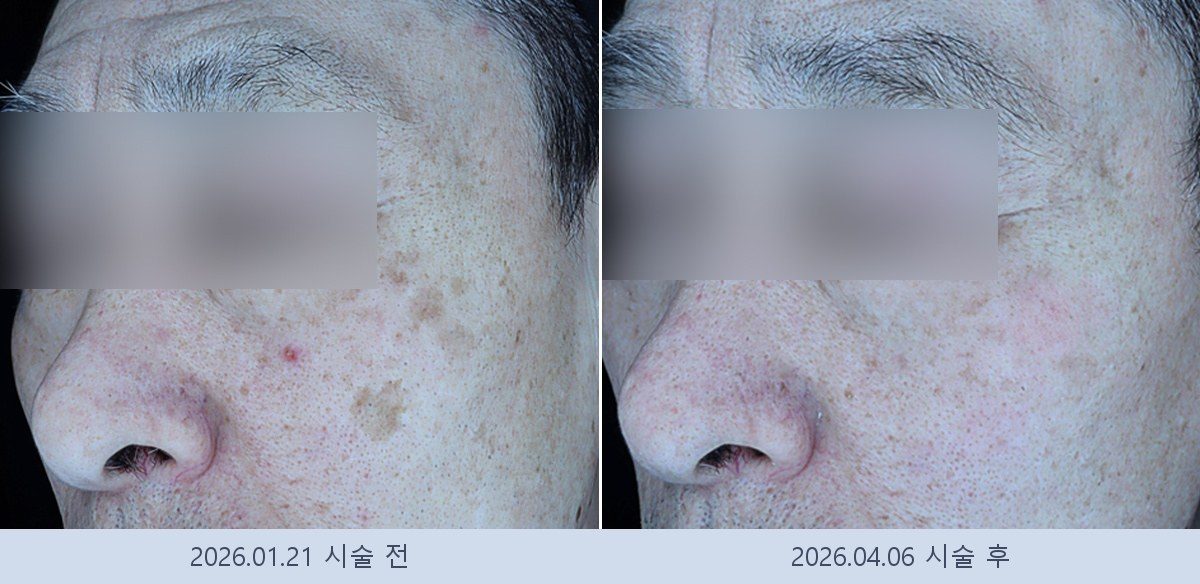 흑자 검버섯