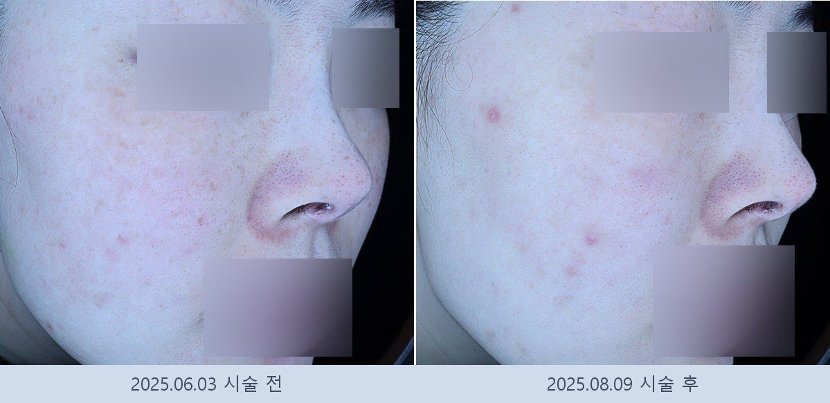 기미 잡티